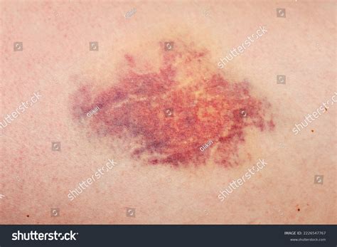 Bruise Large Hematoma On Human Body Stock Photo 2226547767 | Shutterstock