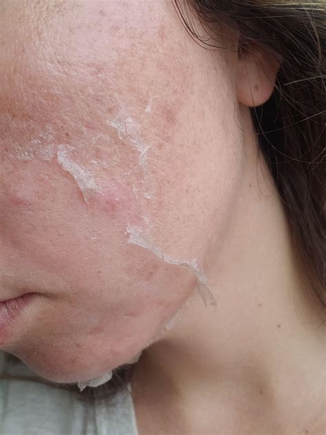 Understanding Blisters After a Chemical Peel | Justinboey