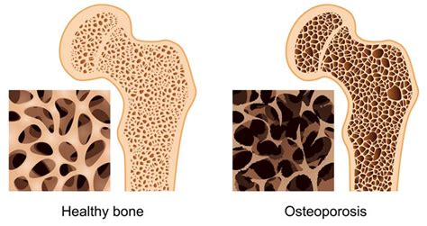 Multiple Sclerosis Foundation - Prevent Osteoporosis with 6 Bone Health ...