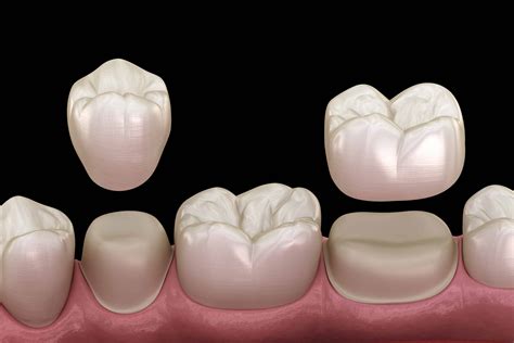 dental crowns  turkey check dental care cost  turkey