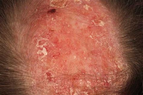 Autoimmune Diseases That Cause Alopecia - MyCapil ️