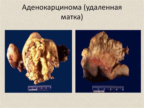Рак шейки и тела матки - презентация онлайн