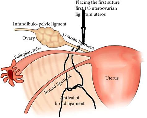 Figure 1 from A New Technique of Oophoropexy: Folding and Fixating of Utero-Ovarian Ligament to ...