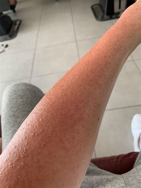 Heat Rash On Arms And Legs