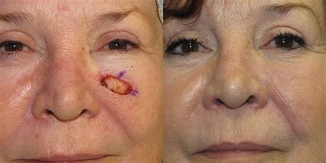 Cheek Reconstruction Gallery | Skin Cancer And Reconstructive Surgery ...