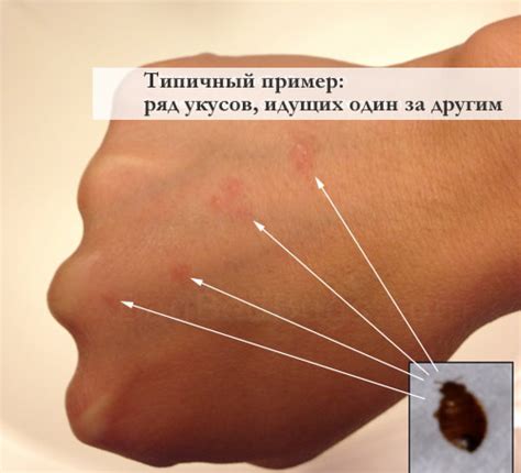 Укусу клопов: симптомы, как выглядят и как бороться с укусами, средства ...