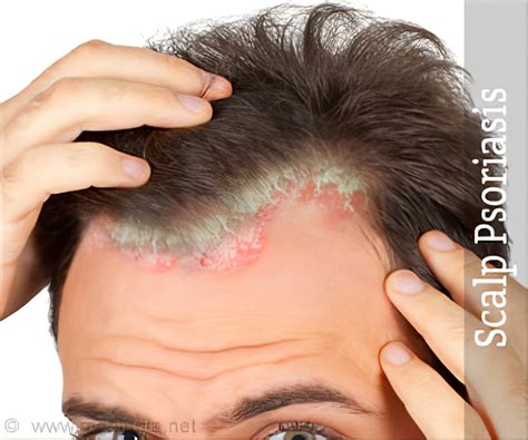 Scalp Psoriasis: Causes And Treatment GoodRx, 44% OFF