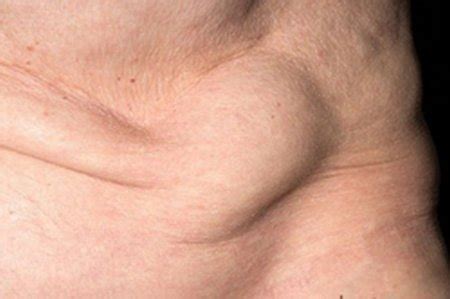Spigelian Hernia - Pictures (Anatomy), Symptoms and Repair