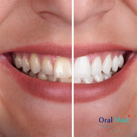 Clareamento Dental A Laser - Clareamento dental a laser - OralMed Odontologia Especializada