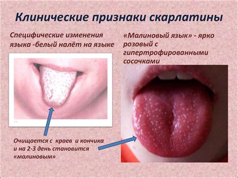 Сестринская помощь при скарлатине и коклюше - презентация онлайн