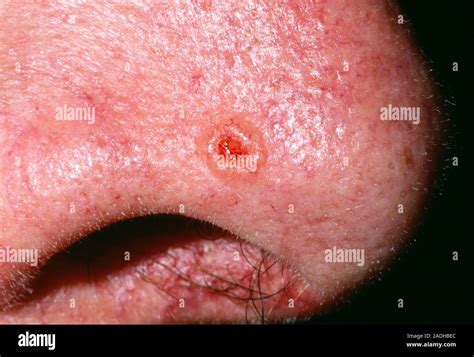 skin cancer close    basal cell carcinoma bcc  rodent ulcer