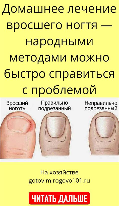 Вросший ноготь на большом пальце как лечить: как избавиться от проблемы ...