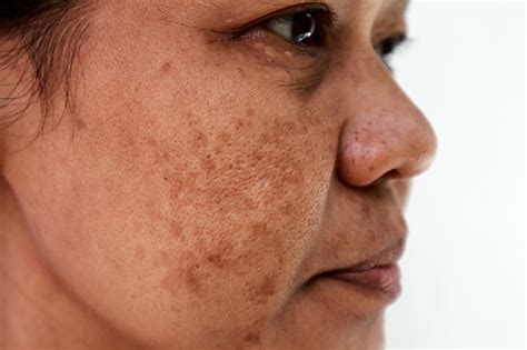 nevus  ota diagnosis treatment prevention