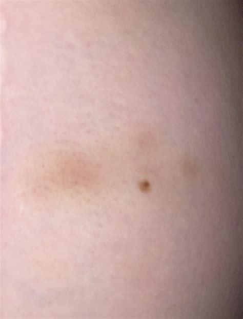 Just need advice. Should I be concerned about this mole? Ignore the