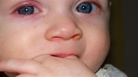 gripi  syrit shtohen rastet  konjuktivitit viral te femijet top