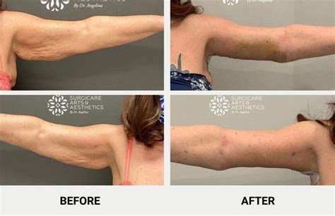 sculpted arms hidden scar invisible arm lift