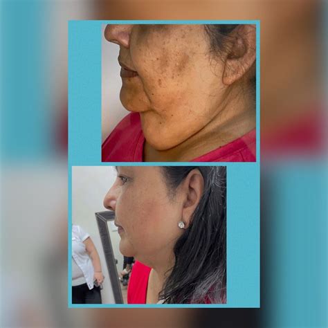 Smart Liposuction Surgery | Houston, TX | Clinic 45