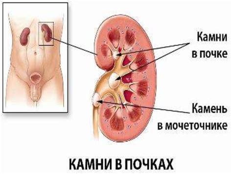 СП при мочекаменной болезни - презентация онлайн