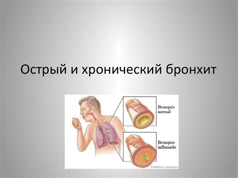 Острый и хронический бронхит - online presentation