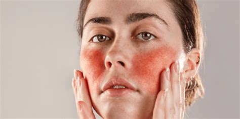 Rosacea Relief: The Best Skincare Solutions | allbeauty