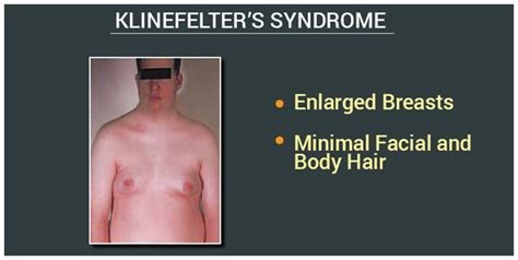 Klinefelter Syndrome- Causes, Symptoms and Treatment