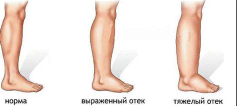 Отеки при давлении и гипертонии: причины, симптомы, лечение