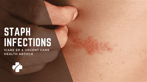 unmasking staph infections  comprehensive guide icare er urgent care