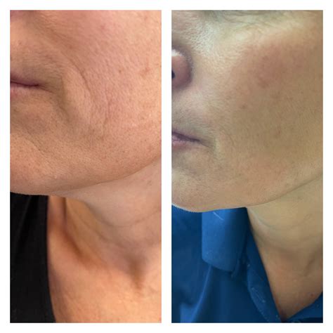 Fibroblast Plasma Pen | Naples Laser & Skin Aesthetics | Naples, FL