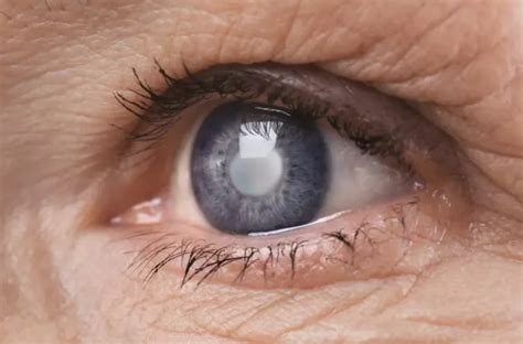 Cataratas: ¿cuáles son los síntomas de esta enfermedad en los ojos? Le ...