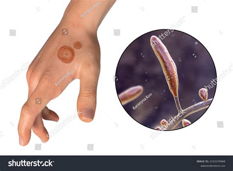 Fungal Infection On Mans Hand Tinea Stock Illustration 2152179469 ...