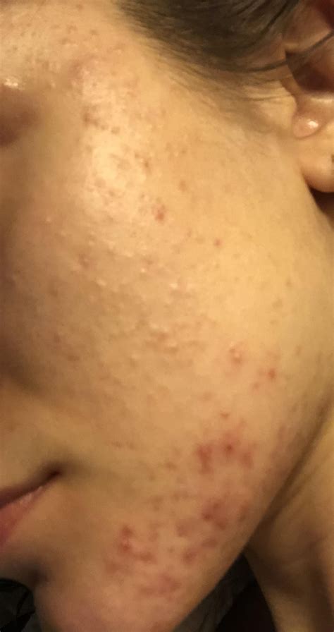 [skin concern] has anyone ever had this many comedones? On chin they