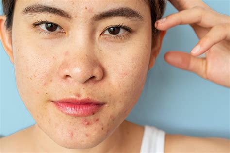 5 Ways to Treat Hormonal Acne Breakouts - Mommy B Knows Best