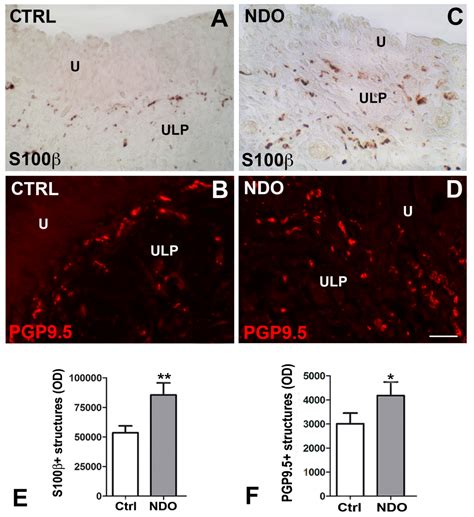 The Botulinum Treatment of Neurogenic Detrusor Overactivity: The Double