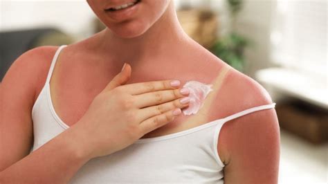 5 Home Remedies For Soothing Sunburn | Summer Skincare Tips