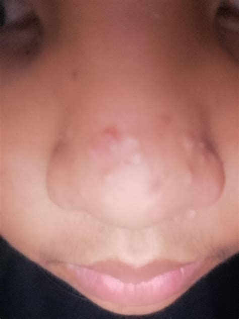 bumps on face that are not pimples 1