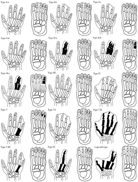 Schematic drawing of non-syndromic syndactyly types. Black digital ...