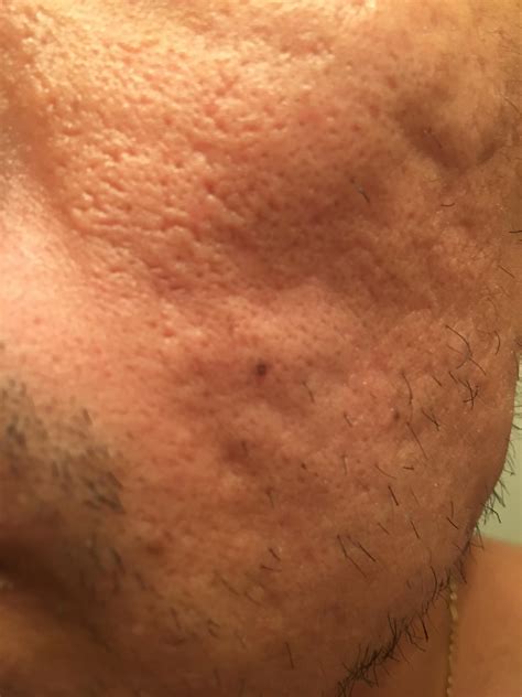 HELP! Please severe acne scars – Hypertrophic (raised) scars – Acne.org
