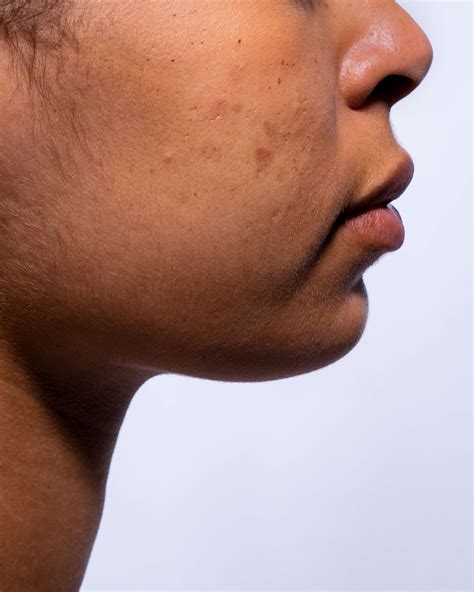 Post-inflammatory Hyperpigmentation: What is it?