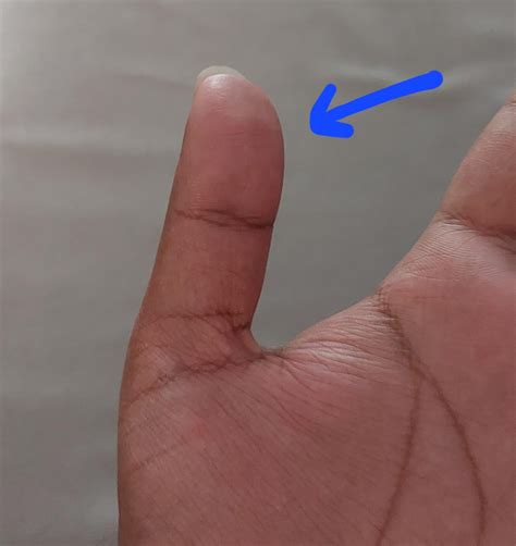 Pain at the tip of my thumb - enthesitis? : r/PsoriaticArthritis
