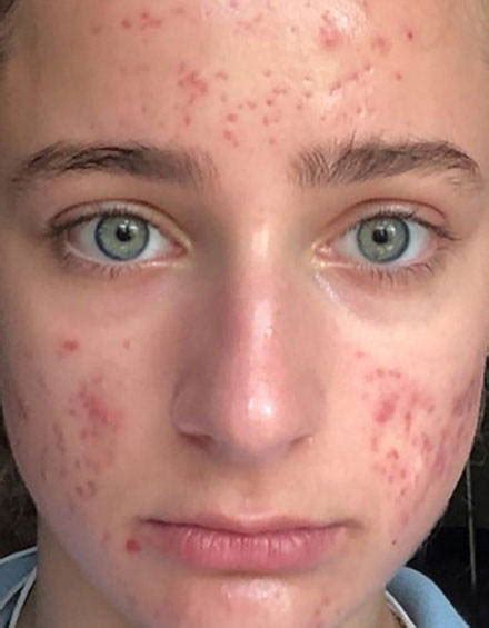 TEEN ACNE | SPA TREATMENTS