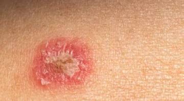 rricoid solusi obat penyakit kulit  ampuh