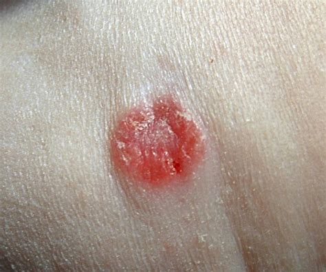 Clinical Image: Primary Skin Lesion