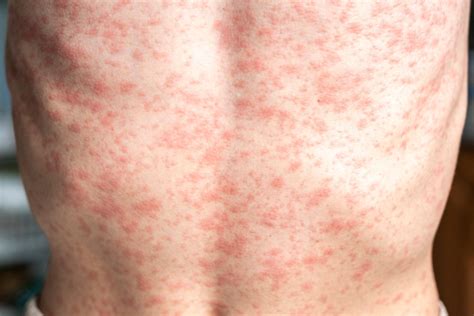 whooping cough outbreak spreads      symptoms vaccines
