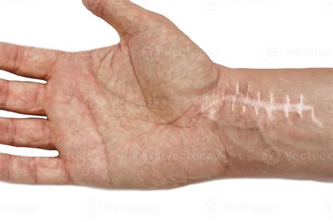Scar with stitches on the wrist after surgery. Fracture of the bones of