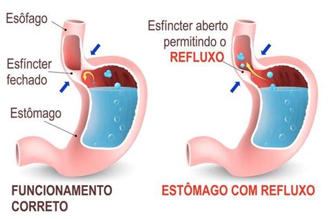 Quais Os Sintomas De Estreitamento No Esôfago - Esôfago: o que é, onde fica e função - Toda Matéria