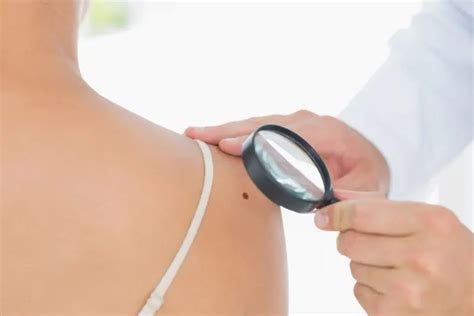 40 Facts About Pityriasis Lichenoides Et Varioliformis Acuta