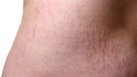 ran da   va  trang nguyen nhan va nhung cach chua hieu qua