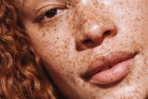 Sun spots vs Freckles : What's The Difference? - the daily glimmer