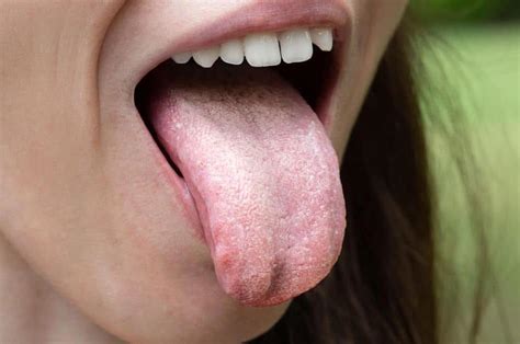 oral thrush tongue