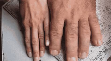 acromegalia    causas sintomas  tratamento